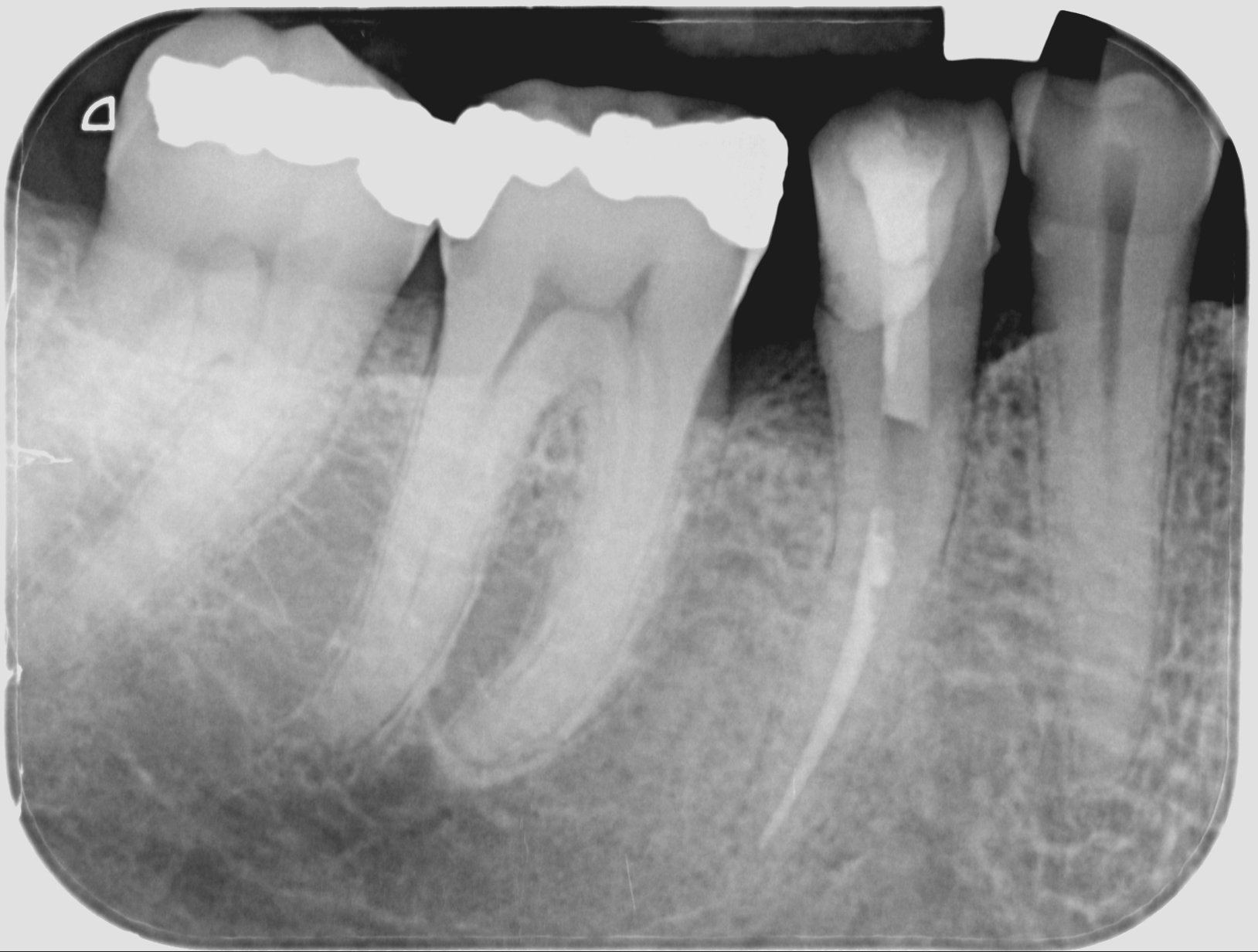 Asahi Intraoral x-ray