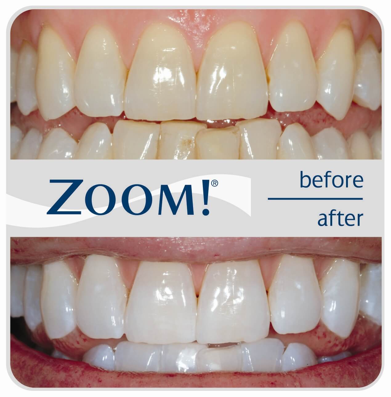 Philip Zoom Whitening