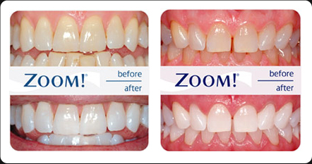 Philip Zoom Whitening